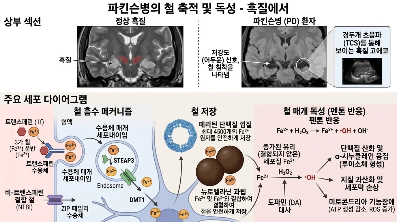 파킨슨병의 철 축적 및 독성 — 흑질에서